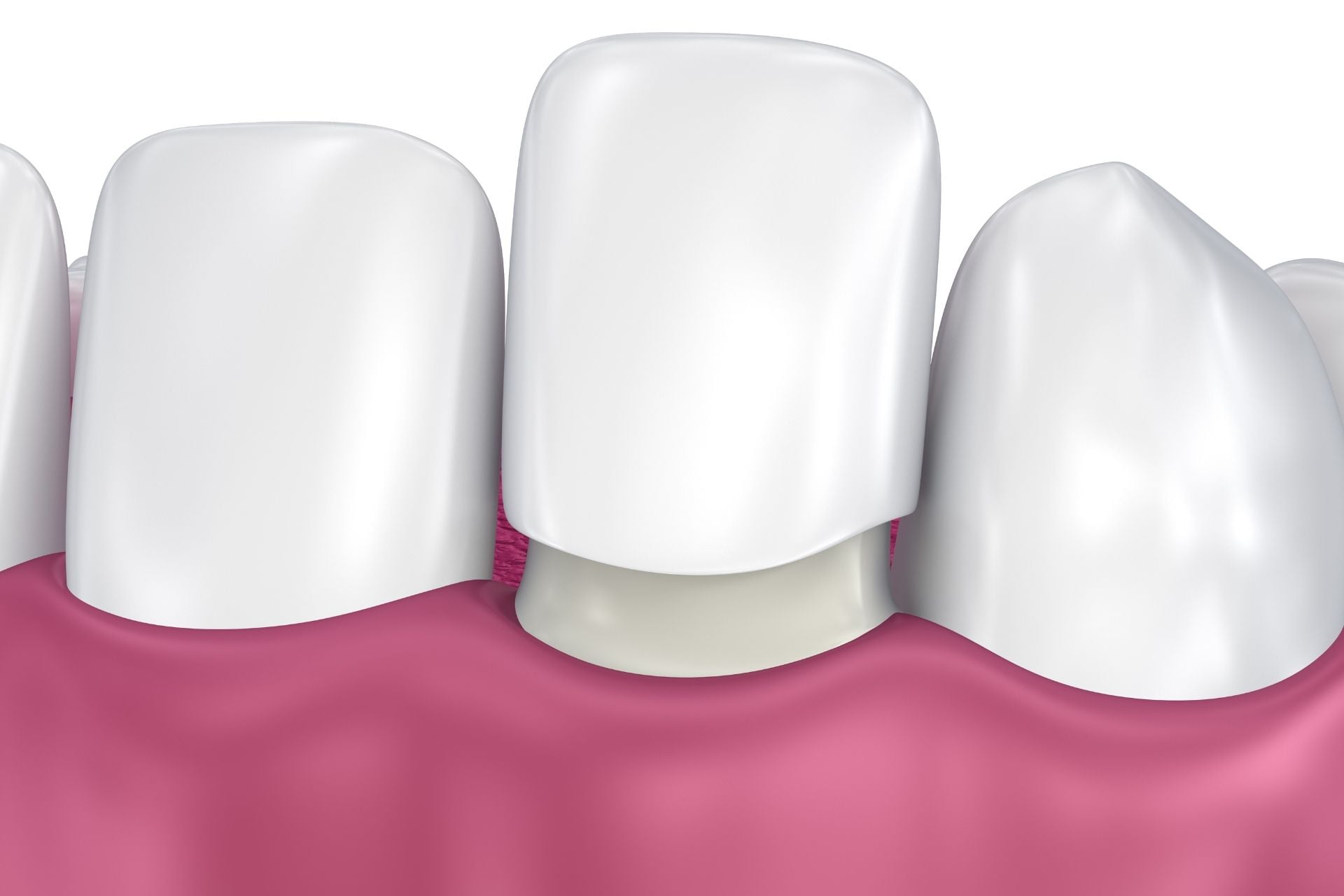 Are Veneers Right for You? Pros and Cons Explained