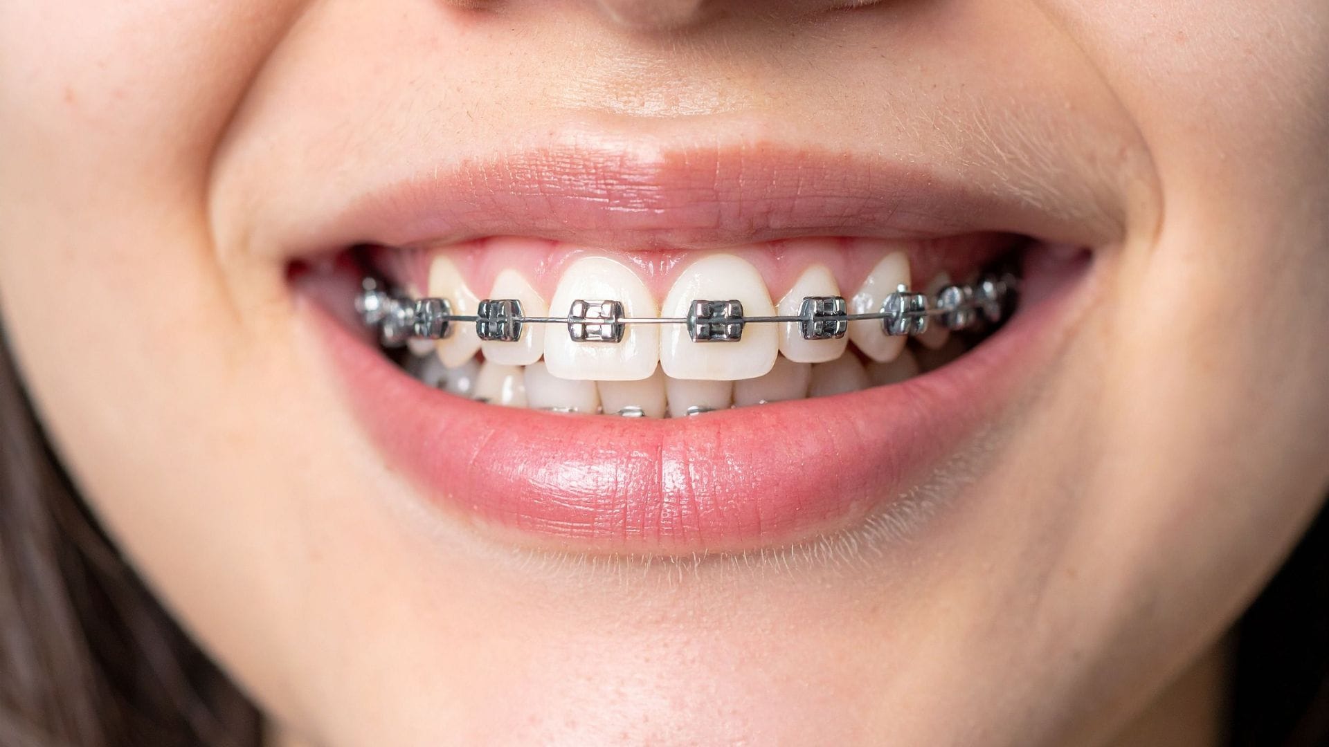 Top Benefits of Choosing Clear Aligners Over Metal Braces